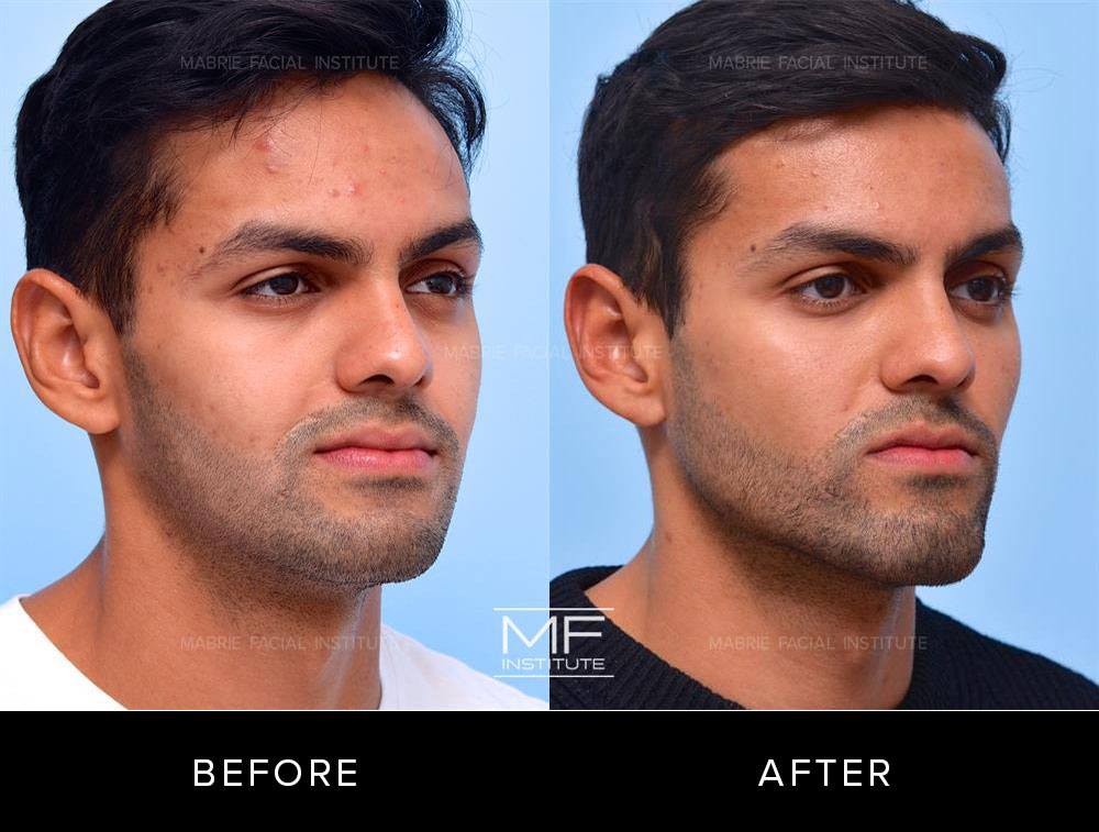 Before and after images of chin and jawline filler patient #721
