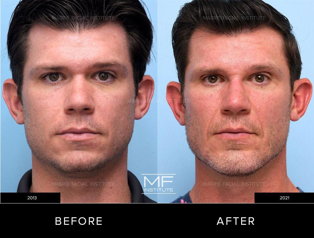 Before and after images of chin and jawline filler patient #690