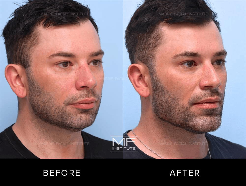 Before and after images of chin and jawline filler patient #726