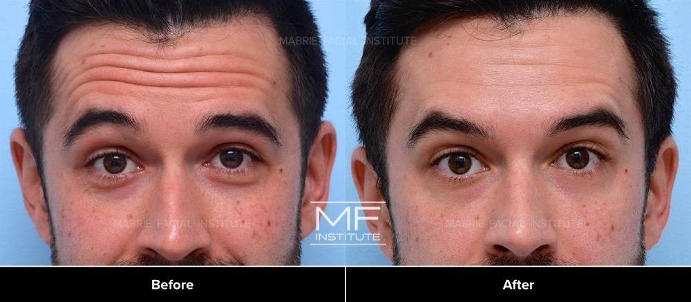 Upper-Face Botox Before & After