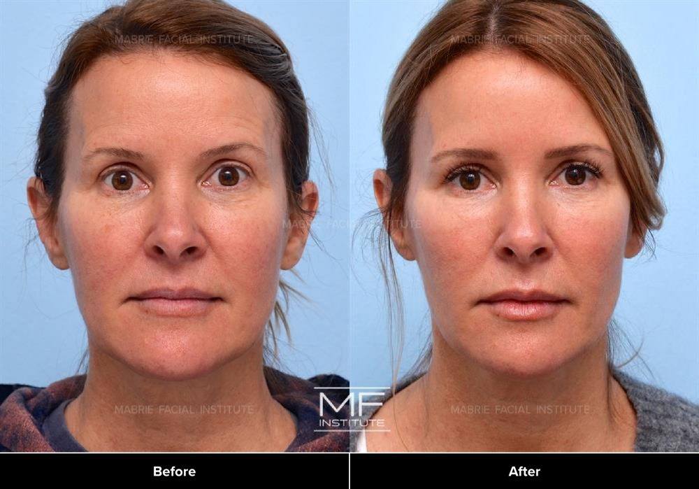 Upper-Face Botox Before & After