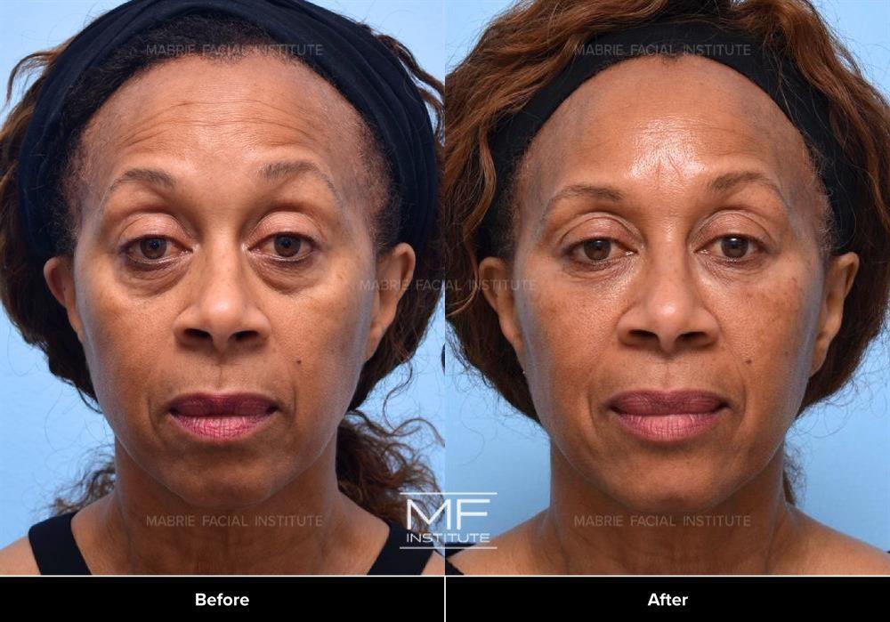 Under eye filler / Midface Rejuvenation Before&After