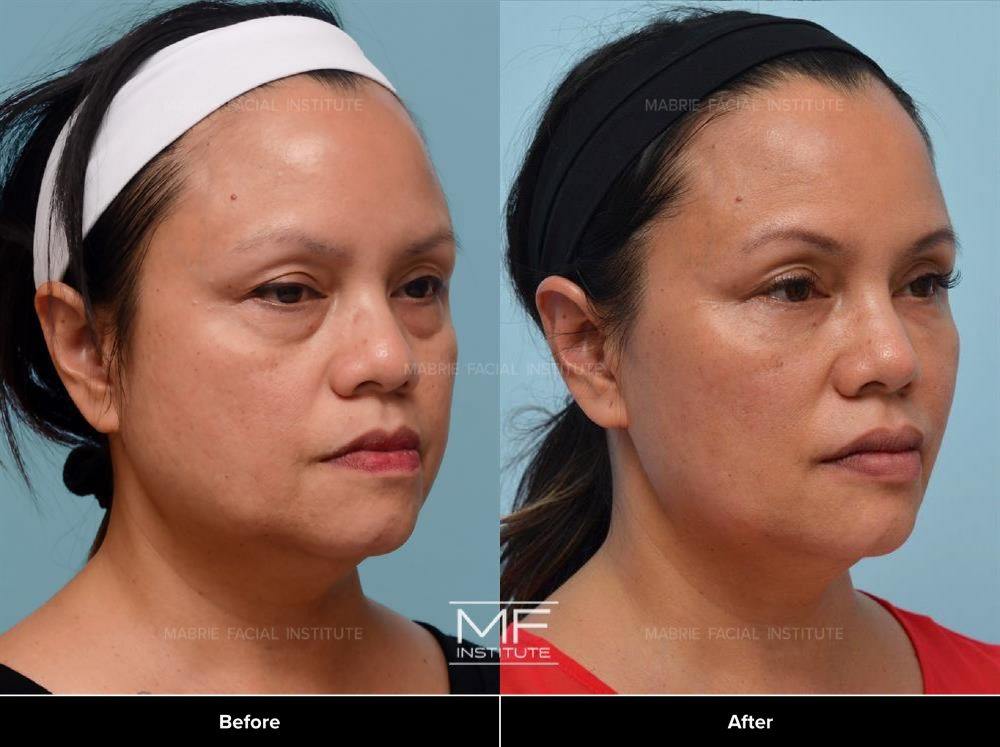 Under eye filler / Midface Rejuvenation Before&After
