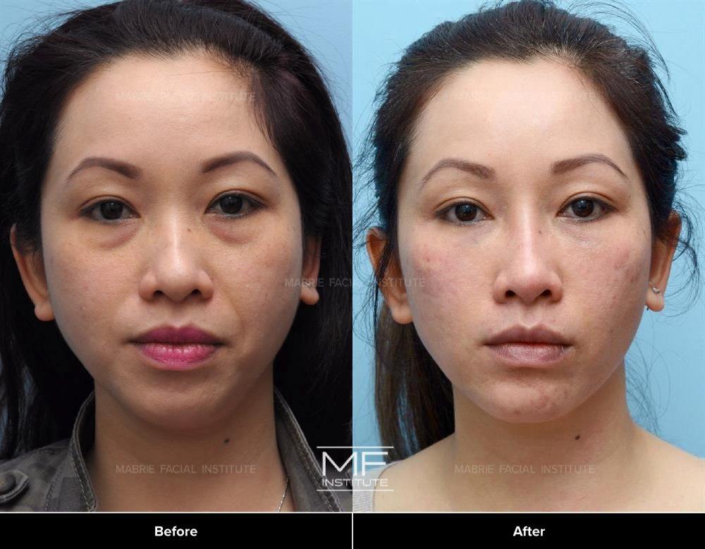 Under eye filler / Midface Rejuvenation Before&After