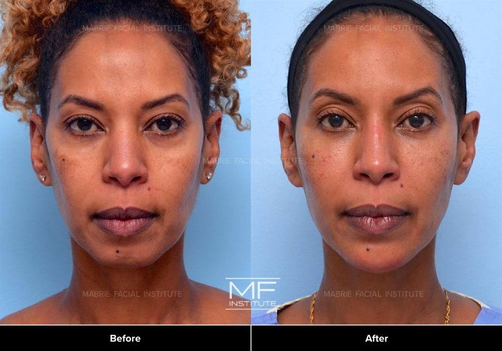 Lower Face Rejuvenation Before & After