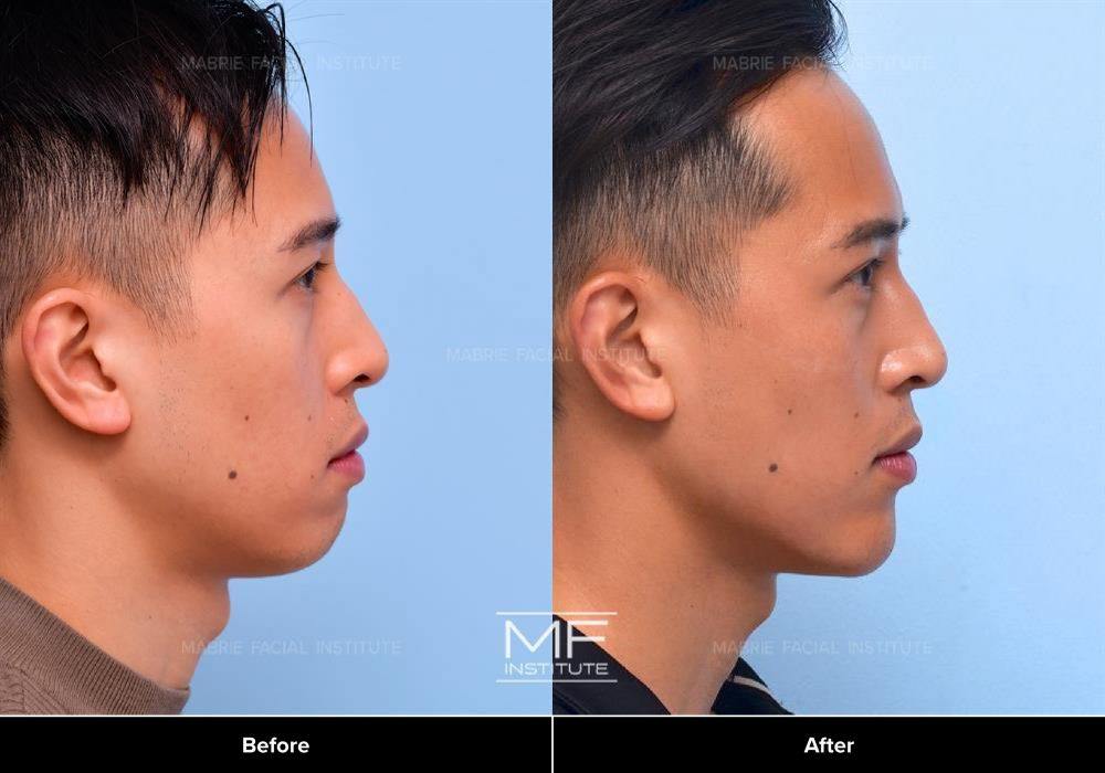Lower Face Rejuvenation Before & After