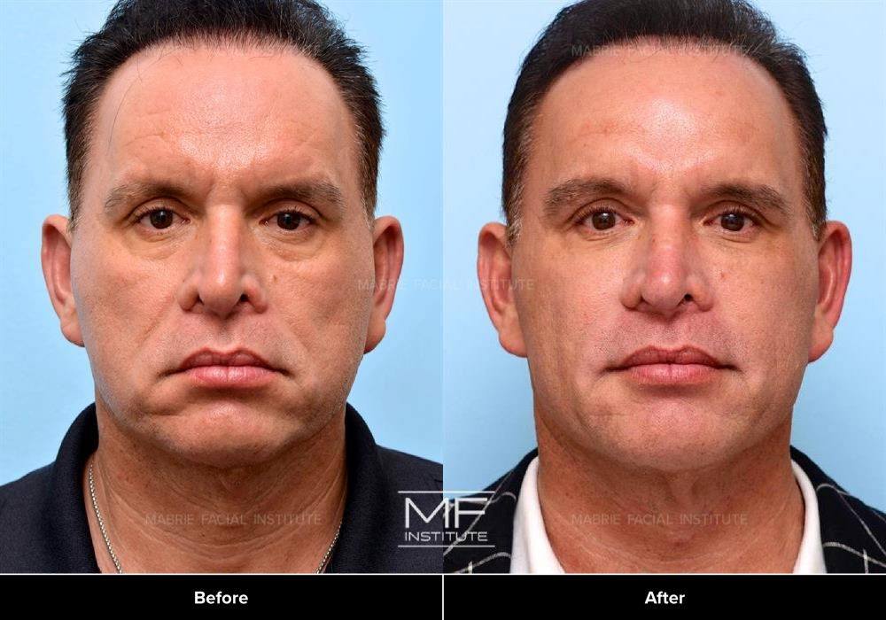 Lower Face Rejuvenation Before & After