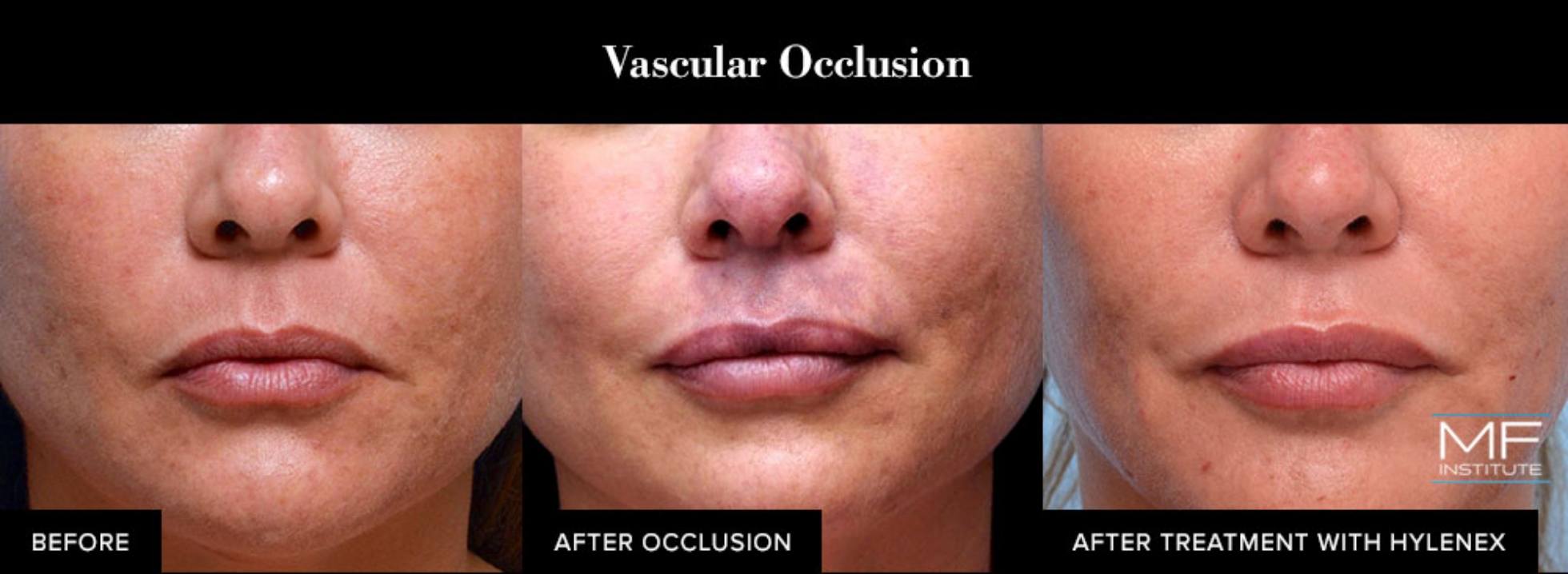 Corrective Injections Dissolving Facial Fillers With Hylenex
