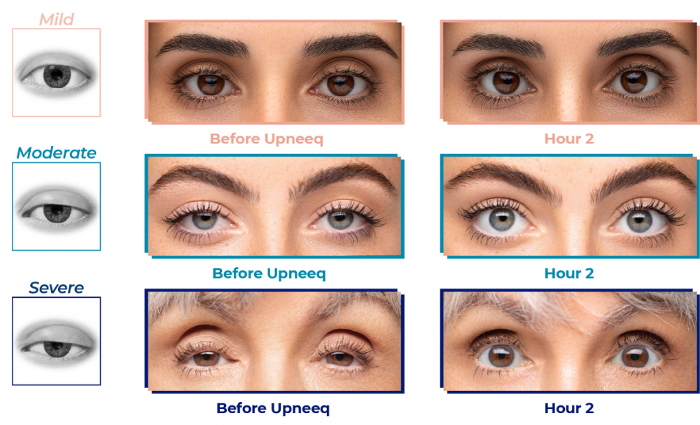 before and after UPNEEQ results on mild, moderate, and severe drooping eyelids