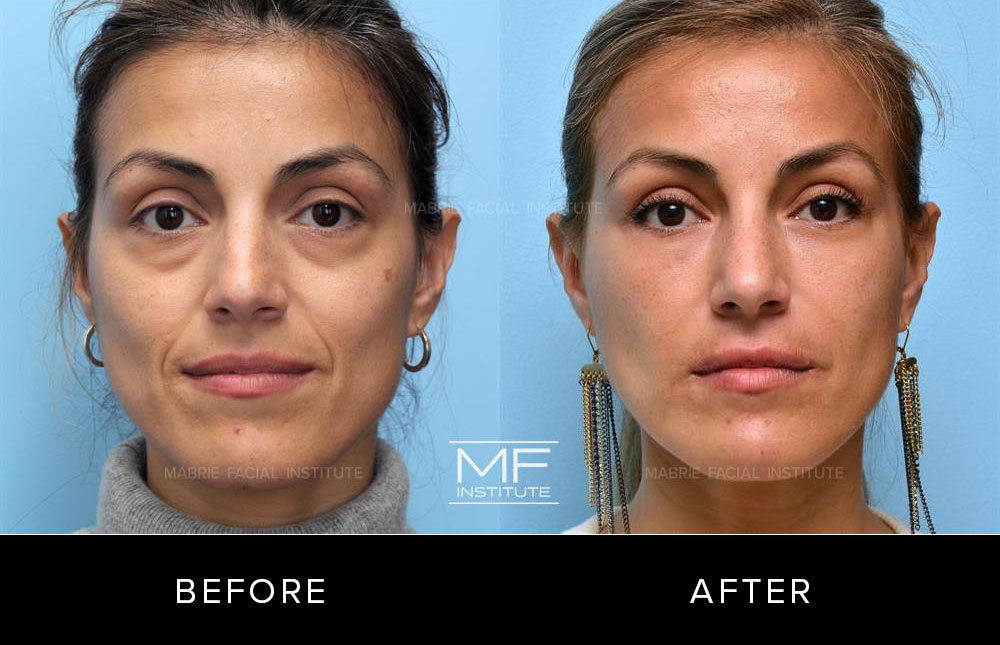 Before and after midface rejuvenation for patient 230