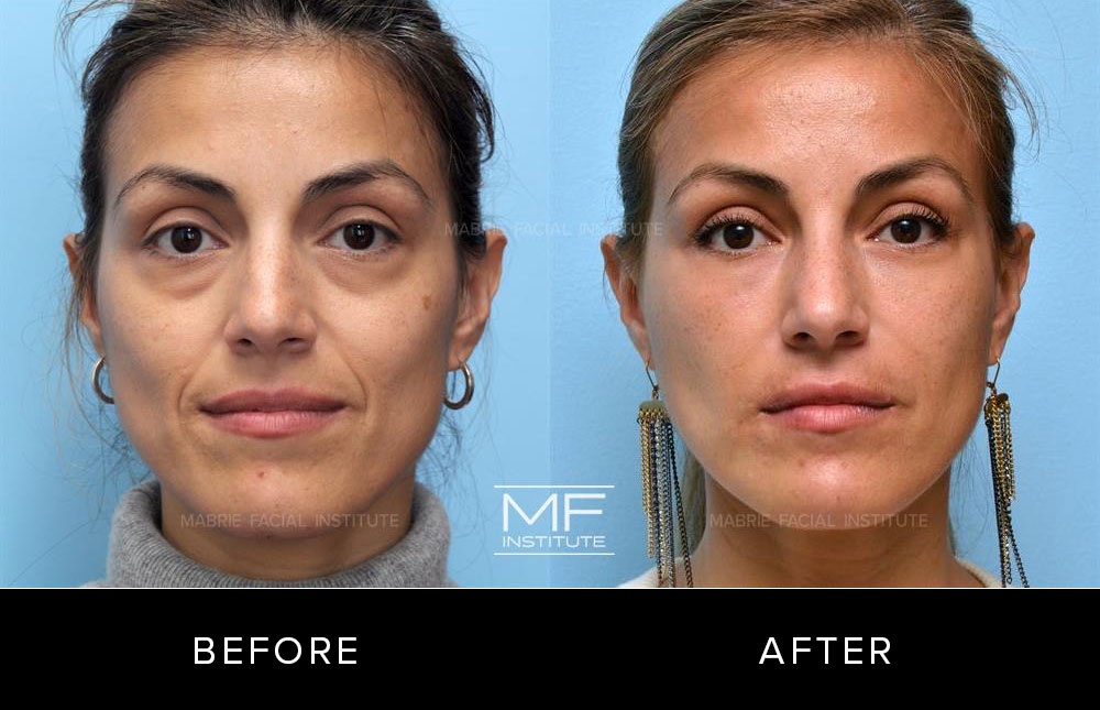 fintælling Overlegenhed barriere How To Look Good Without Makeup: Fillers & BOTOX