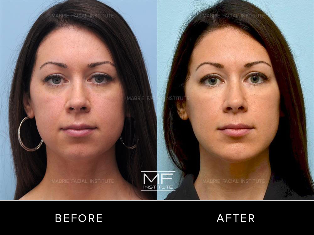 Before and after chin and jawline contouring for patient 237