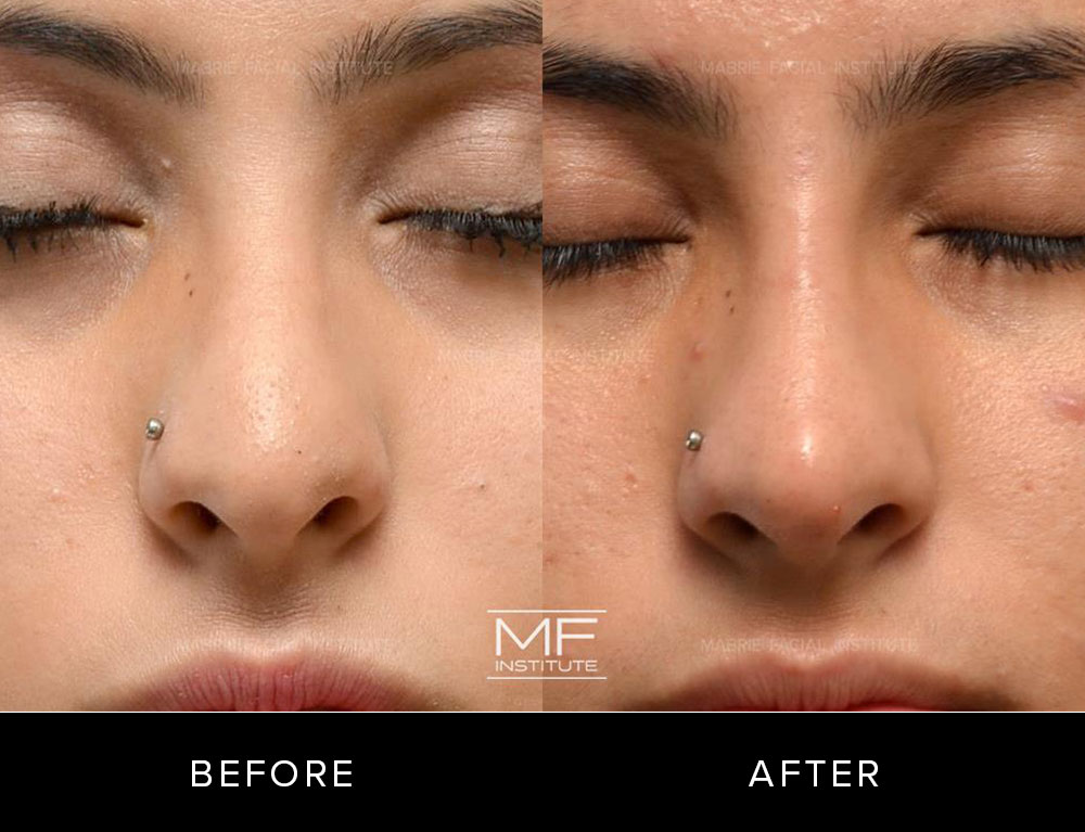 Before and after non surgical rhinoplasty for patient 338