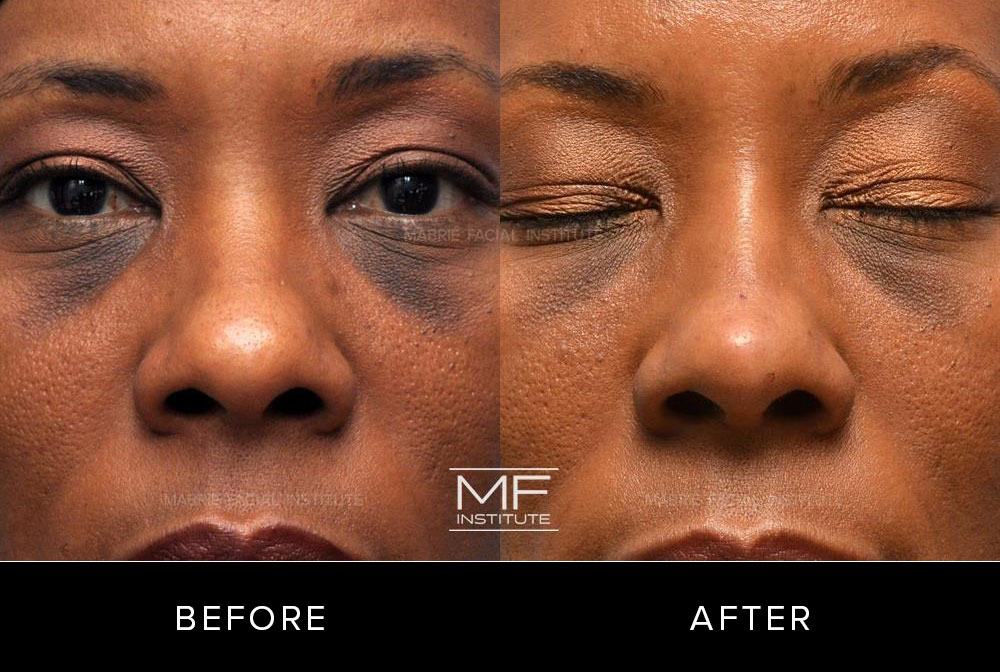 Before and after non surgical rhinoplasty for patient 312