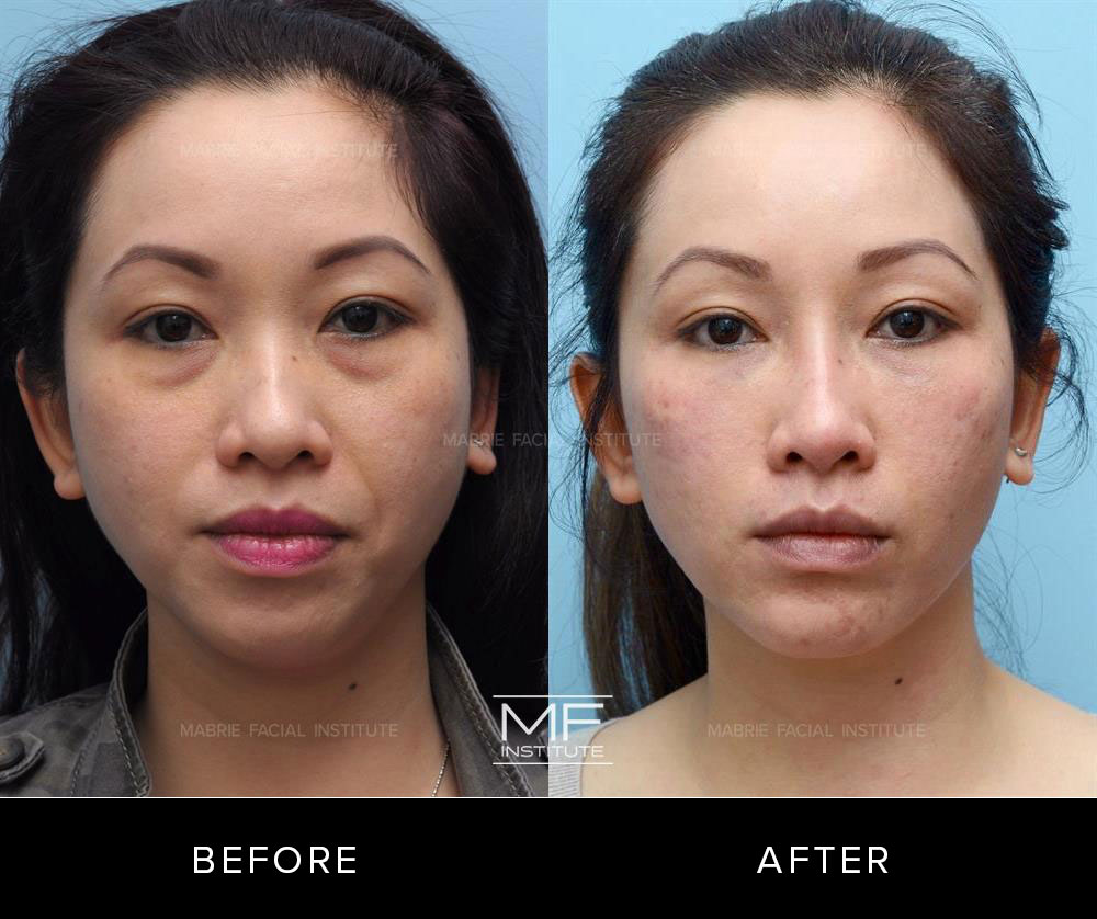 Before and after midface rejuvenation for patient 375