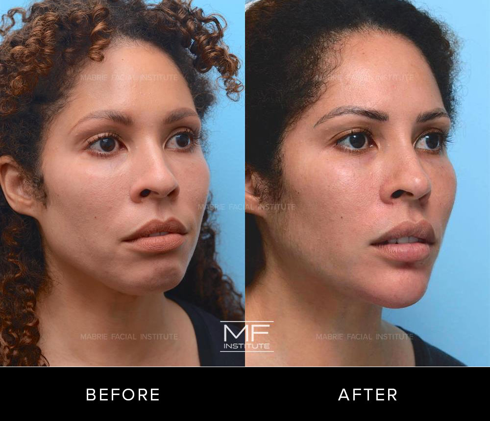Before and after chin and jawline contouring for patient 425