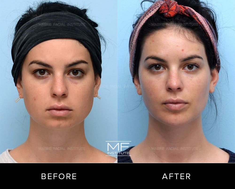 Before and after cheek and chin contouring for patient 432