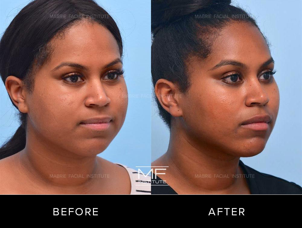 Before and after cheek and chin contouring for patient 504
