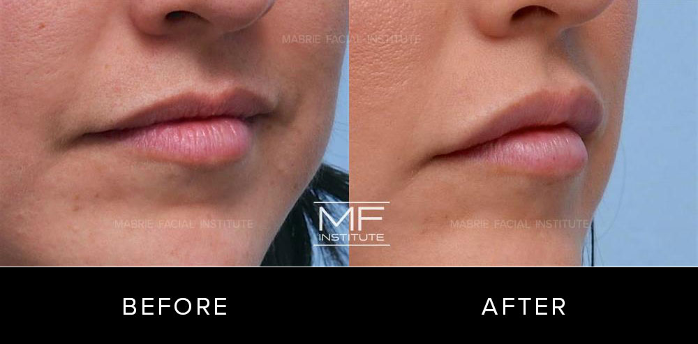 Before and after lip contouring for patient 517