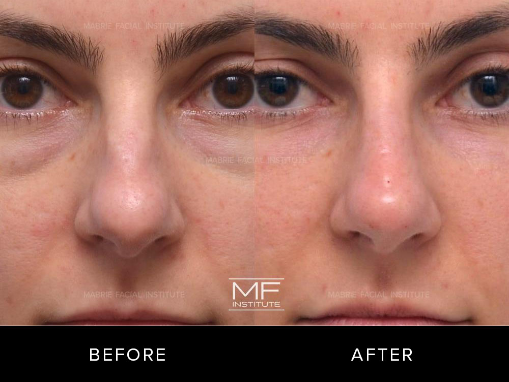 Before and after non surgical rhinoplasty for patient 535