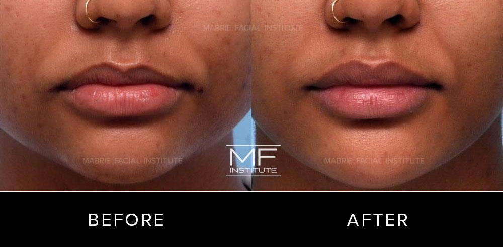 Before and after lip contouring for patient 573