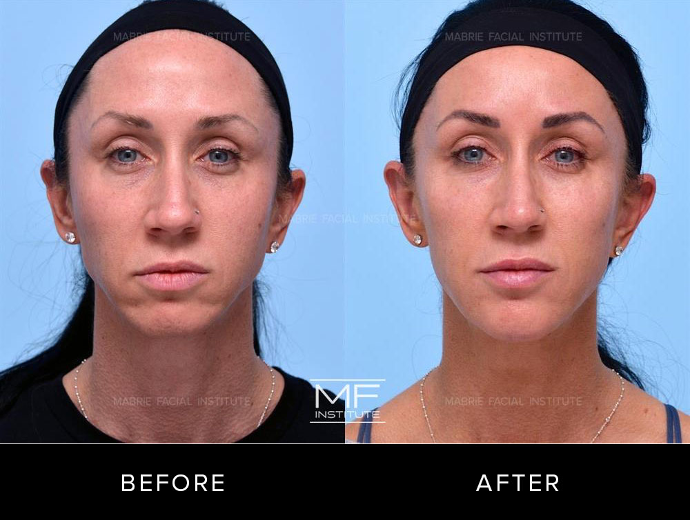 Before and after full face rejuvenation for patient 624