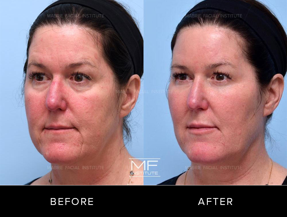 Before and after non surgical facelift for patient 723