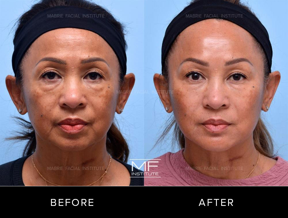Before and after non surgical facelift for patient 735