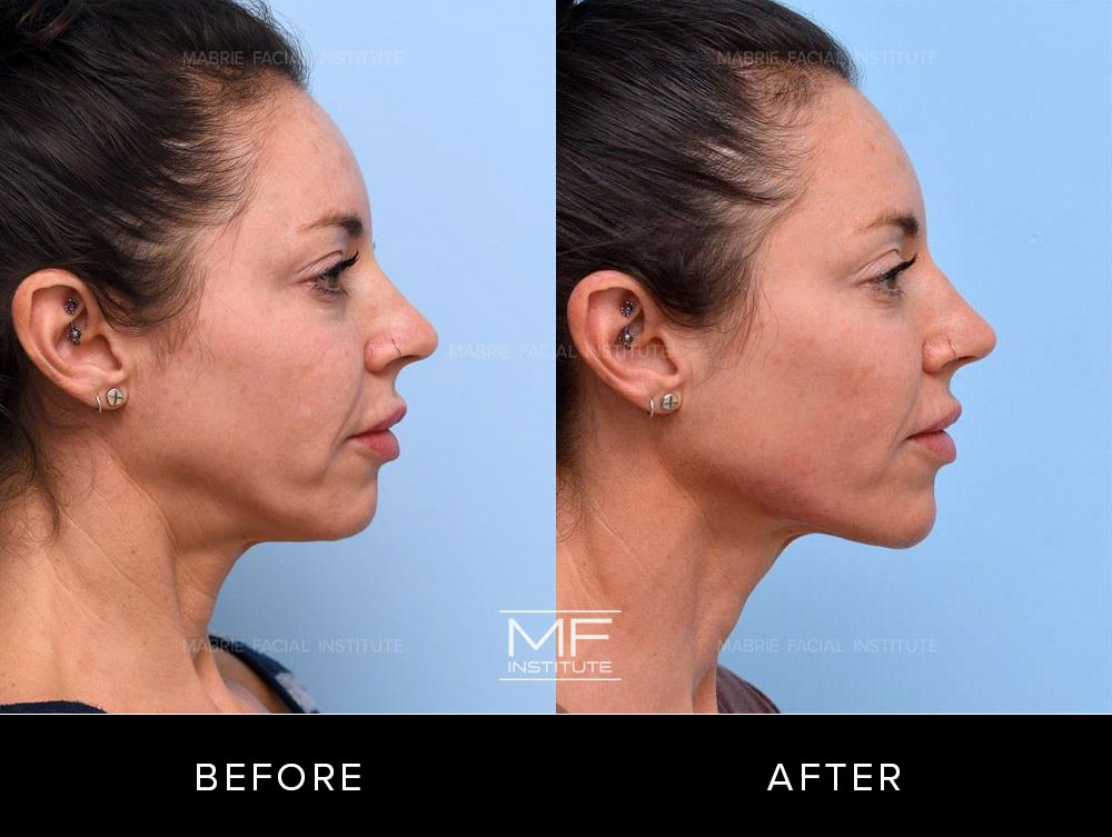 Before and after chin and jawline contouring for patient 738