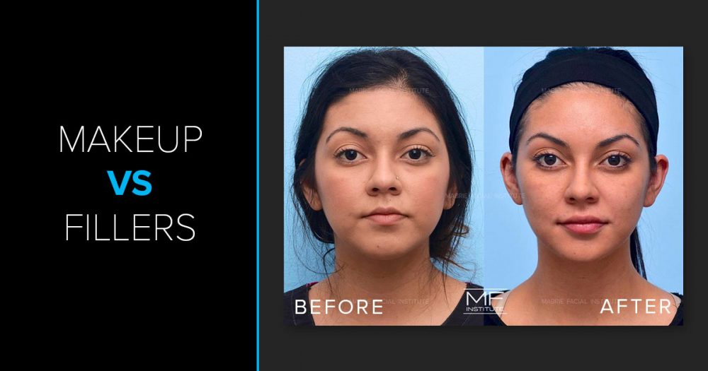 Before and after full face treatment and text that reads, "Makeup vs. Fillers"