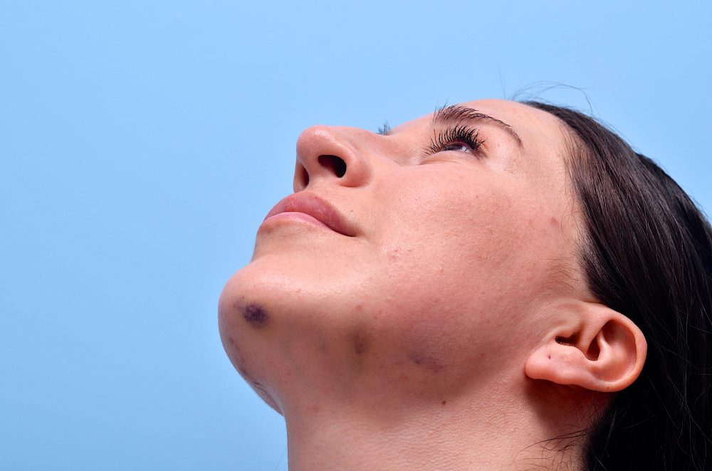 A woman's bruises along her jawline after jawline filler treatment