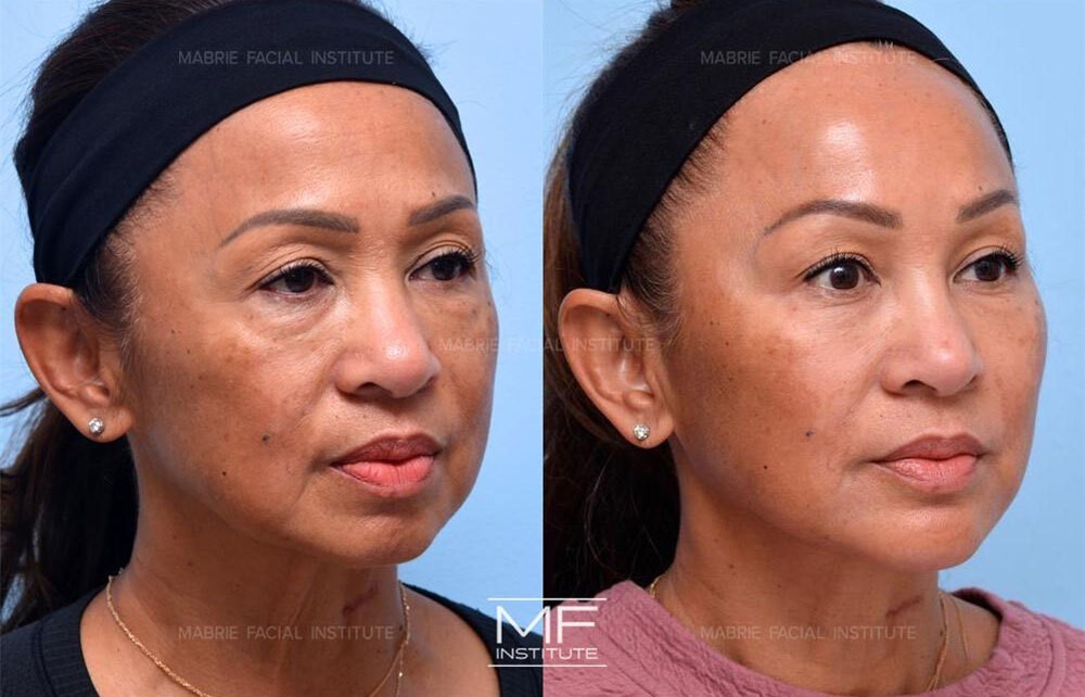 Before and after photos of chin and jawline patient case 735