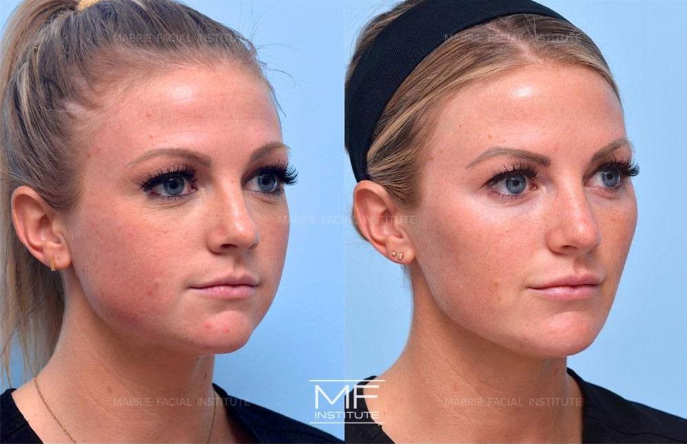 Blog Author (Kimberly) Before and After Jawline Filler