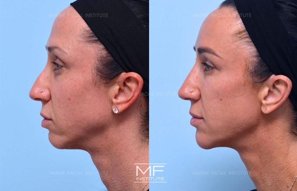 Before and after photos of patient case #624 who received jawline filler