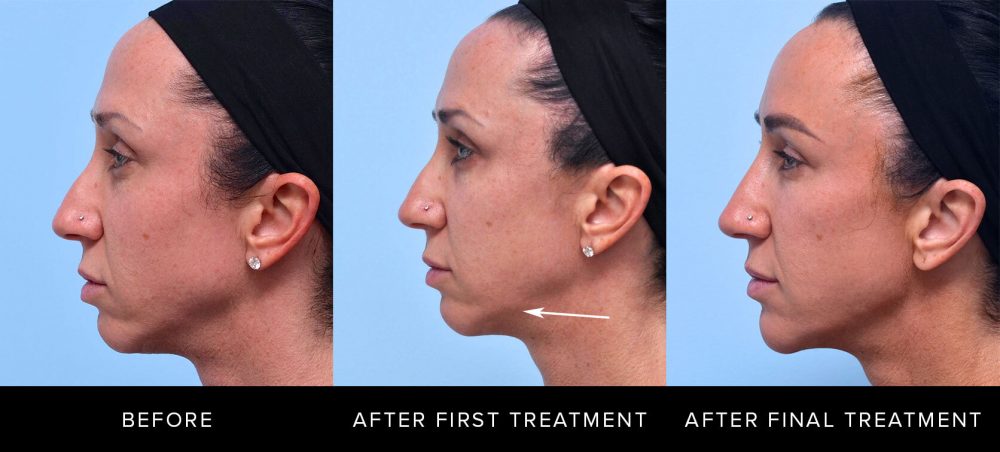 progression of jawline before treatment, after initial treatment (shows slight bump), and after final treatment.