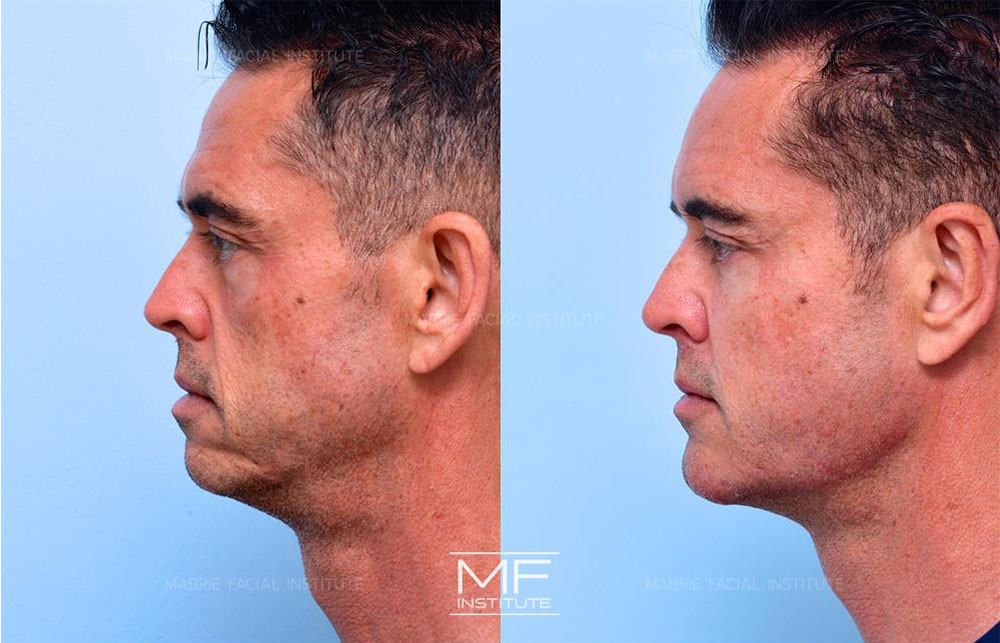 Before and after photos of patient case #645 who received jawline filler