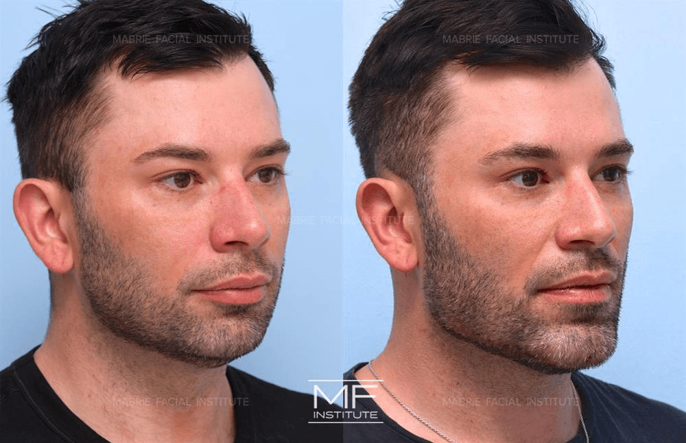 Oblique angle before and after photos of chin and jawline patient case 726