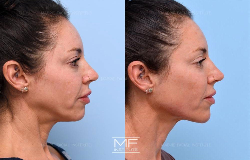 Profile angle before and after photos of chin and jawline patient case 738 