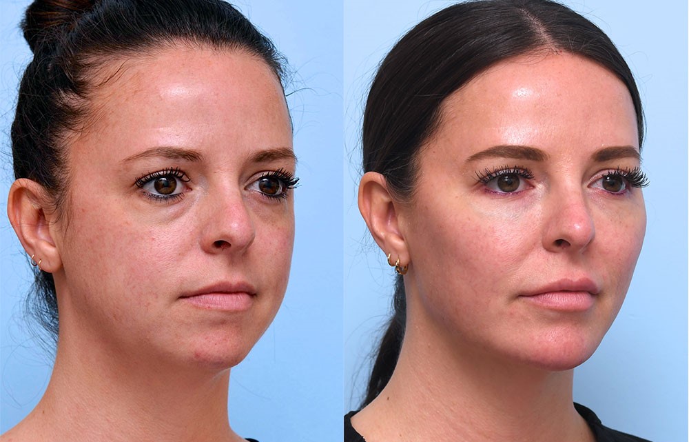 Oblique angle before and after photos of chin and jawline patient case 434