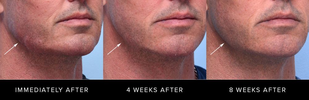 Jawline swelling immediately after, 4 weeks after, and 8 weeks after treatment