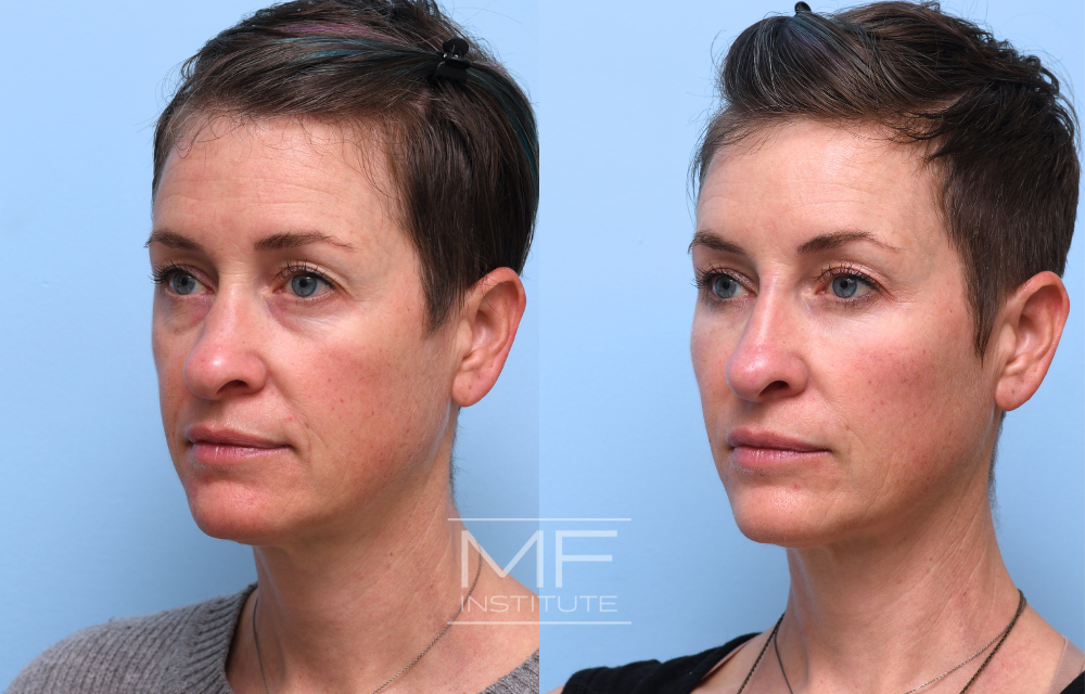 Before-and-after under eye filler for improving dark circles case #769