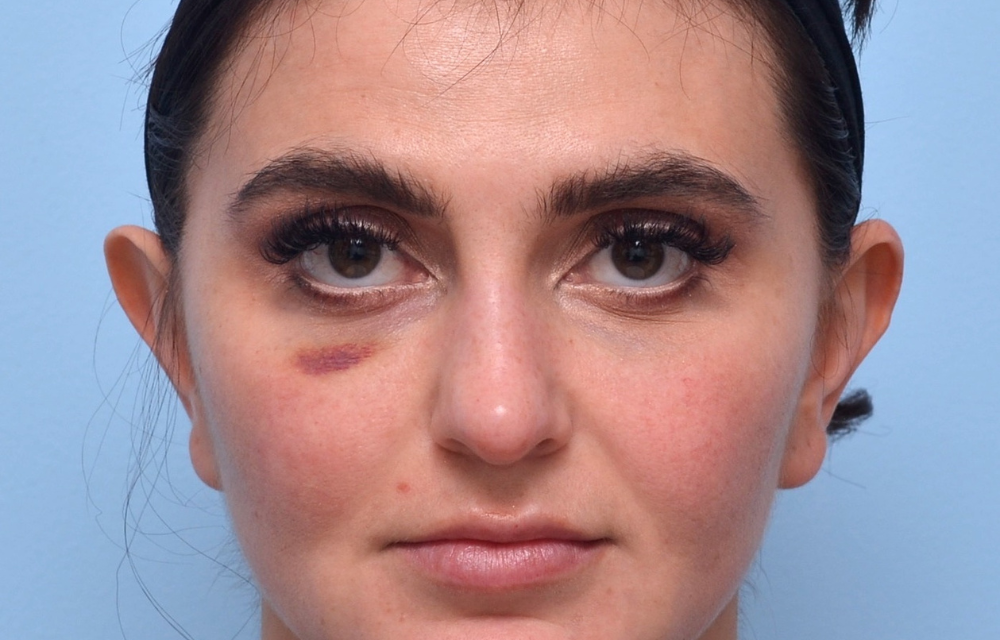 Woman with bruising after under eye filler