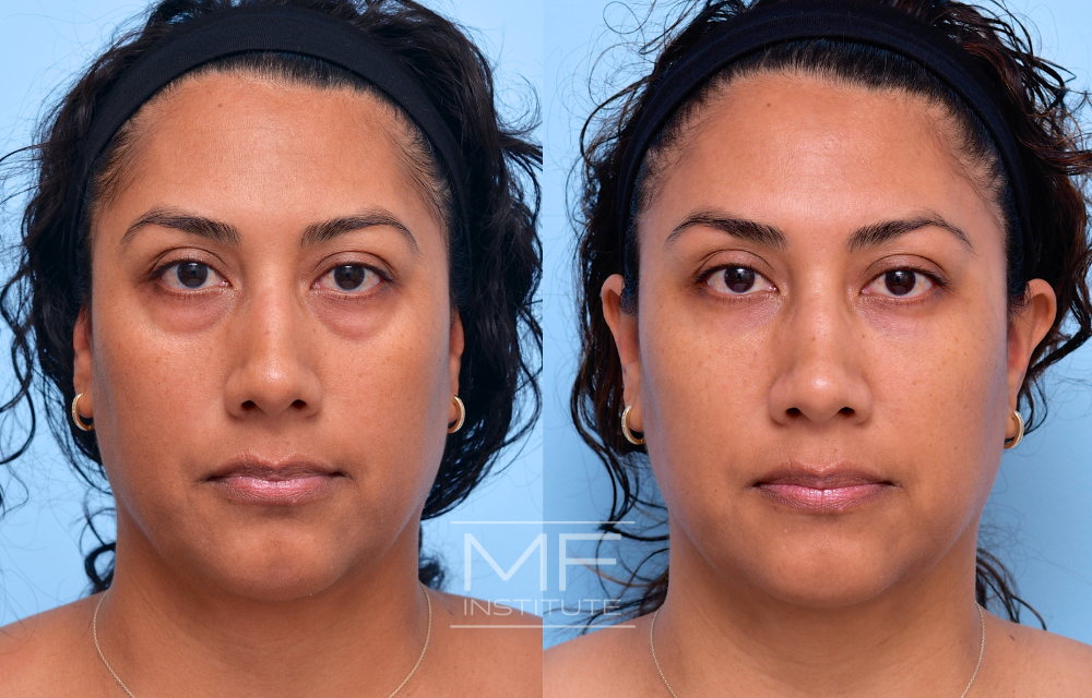 Before and after under eye filler for improving under eye bags case #641
