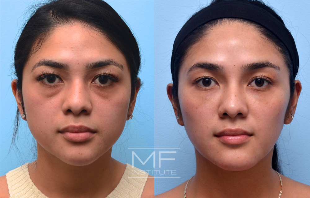 Before and after under eye filler for a patient in their 20s case #584