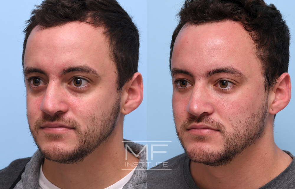 Before and after under eye filler for a patient in their 30s case #737