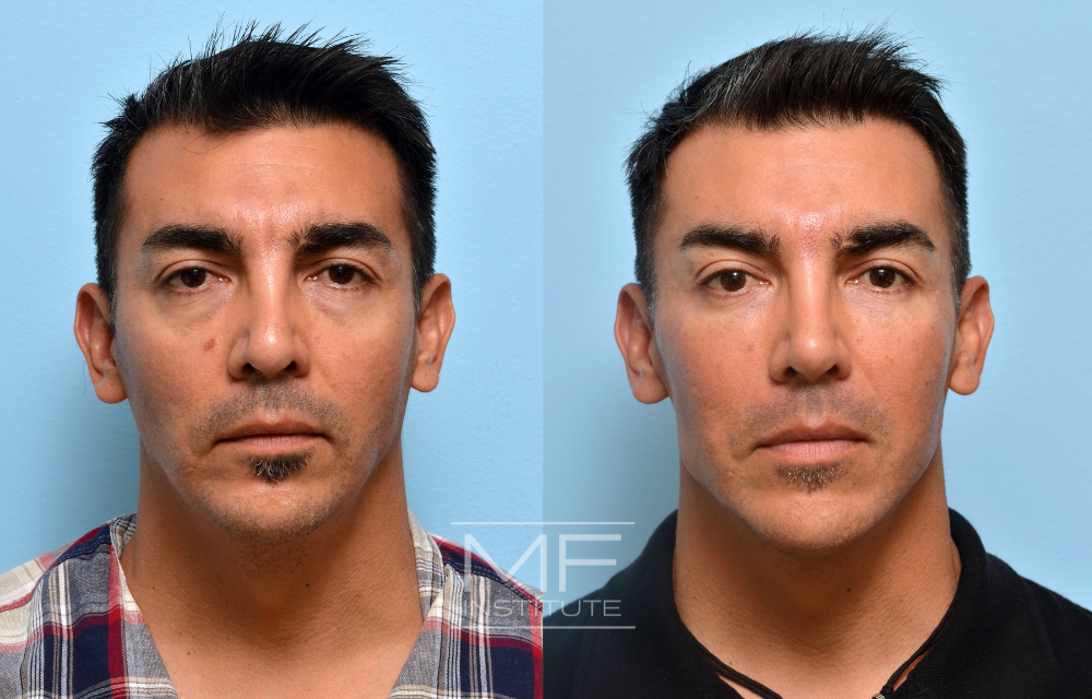 Before and after under eye filler for a patient in their 40s case #404