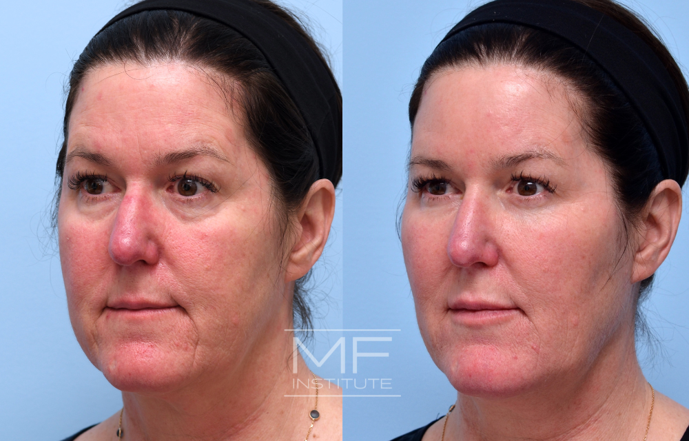 Before and after under eye filler for a patient in their 50s case #723