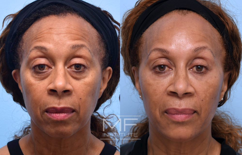 Before and after under eye filler for a patient in their 60s case #603