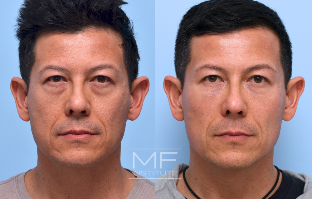Before-and-after under eye filler case #739