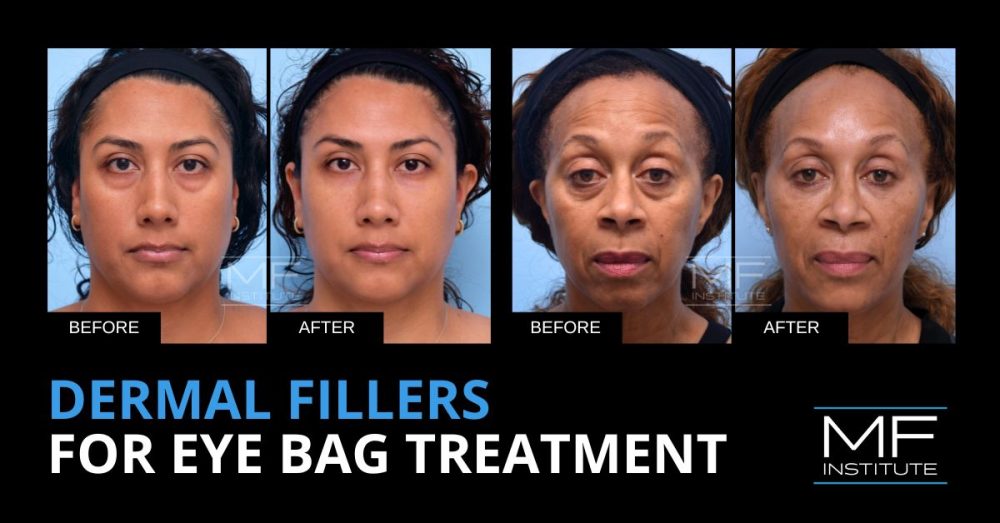 Before-and-after results of MFI under eye filler patients and text that reads 'Dermal Fillers For Eye Bag Treatment'